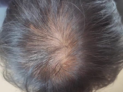 雄激素性脫髮頭頂有一塊頭髮稀疏區圖 雄激素性脫髮頭頂有一塊頭髮稀疏區圖