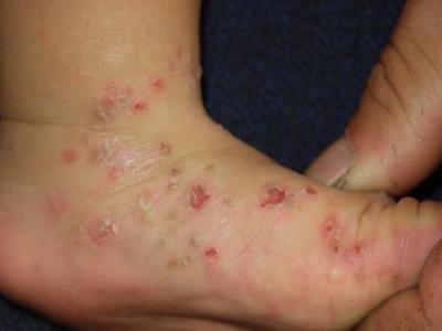 嬰兒肢端膿皰病腳背多處破潰結痂圖
