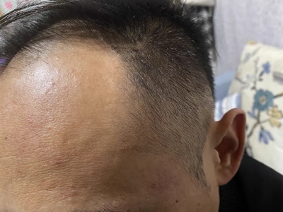 雄激素性脫髮髮際線後退頭髮變少圖