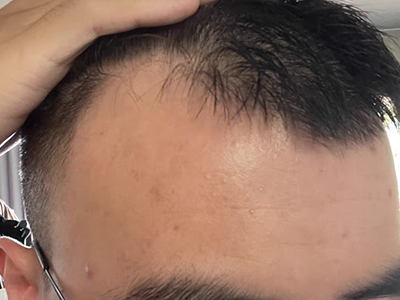 雄激素性脫髮前額邊上禿了一大塊圖 雄激素性脫髮前額邊上禿了一大塊圖