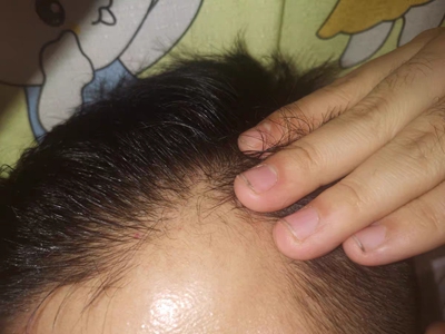 雄激素性脫髮額角髮際線明顯後退圖 雄激素性脫髮額角髮際線明顯後退圖