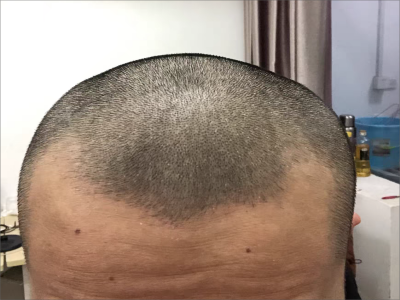 雄激素性脫髮前額兩端髮際線後移圖 雄激素性脫髮前額兩端髮際線後移圖
