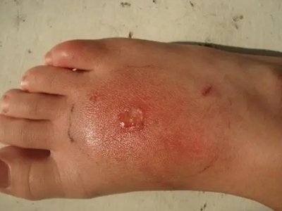 蠓蟲叮咬腳背上長水皰破了圖 蠓蟲叮咬腳背上長水皰破了圖