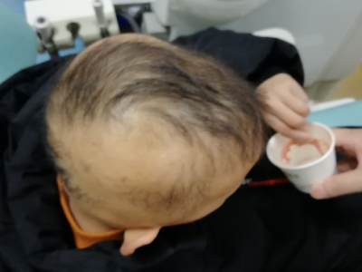 先天性外胚葉發育不良患兒頭髮稀疏圖