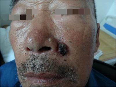 結節型黑色素瘤面部長黑色大疙瘩圖 結節型黑色素瘤面部長黑色大疙瘩圖