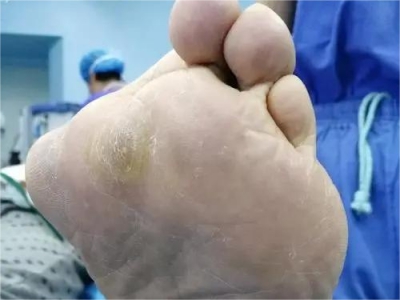 胼胝前腳掌有一個硬硬的黃色疙瘩圖 胼胝前腳掌有一個硬硬的黃色疙瘩圖