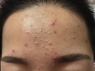 化妝品性痤瘡額頭有數個小丘疹圖 化妝品性痤瘡額頭有數個小丘疹圖