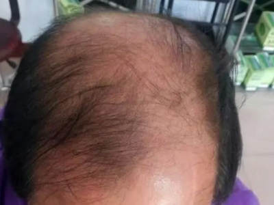 男性型脫髮頭頂頭皮大面積裸露圖 男性型脫髮頭頂頭皮大面積裸露圖