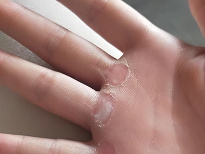 胼胝手掌脫皮有輕微突出的硬塊圖 胼胝手掌脫皮有輕微突出的硬塊圖