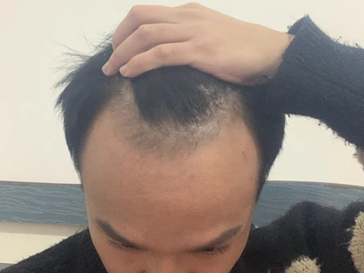 雄激素性脫髮前額兩側脫頭髮圖