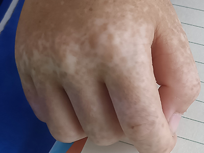 遺傳性對稱性色素異常症手背部有斑圖 遺傳性對稱性色素異常症手背部有斑圖