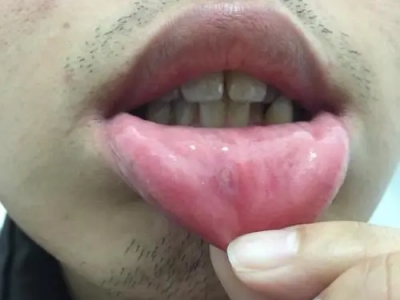 一期口腔梅毒下嘴唇有橢圓形凸起圖 一期口腔梅毒下嘴唇有橢圓形凸起圖