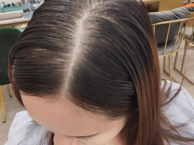 女性型脫髮頭頂發縫明顯圖