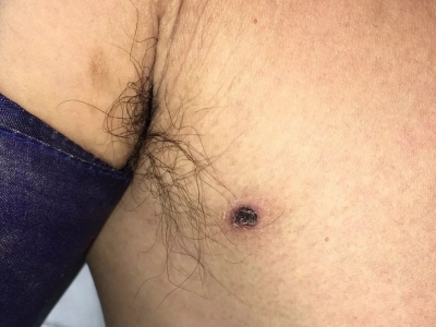 恙蟲病腋窩下有一個焦痂周圍發紅圖 恙蟲病腋窩下有一個焦痂周圍發紅圖