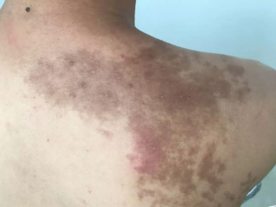 色素性毛表皮痣後背長斑圖 色素性毛表皮痣後背長斑圖