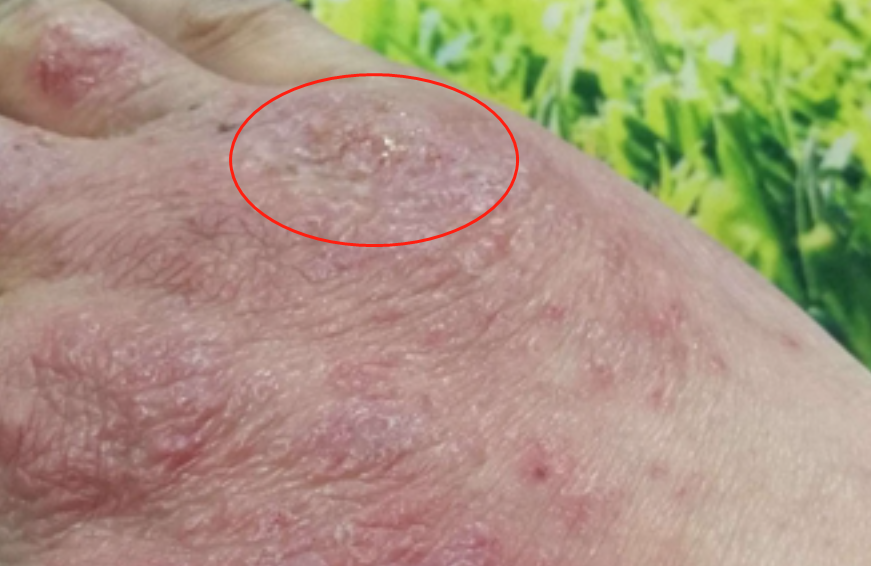 手部濕疹手背紅斑水皰破裂流黃水圖