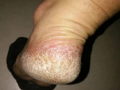 手足皸裂腳後跟皮膚增厚有裂紋圖 手足皸裂腳後跟皮膚增厚有裂紋圖