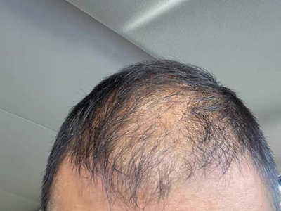 雄激素性脫髮前額一側髮際線後移圖 雄激素性脫髮前額一側髮際線後移圖