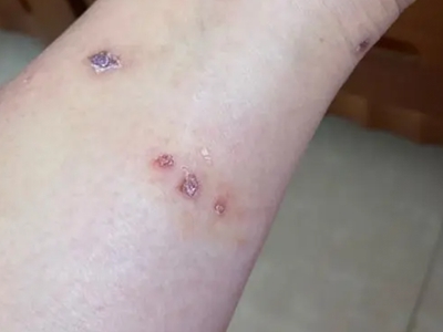 蠓蟲叮咬小腿上結痂圖 蠓蟲叮咬小腿上結痂圖