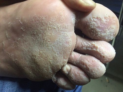 溝狀跖部角質松解症腳底大量小坑圖 溝狀跖部角質松解症腳底大量小坑圖