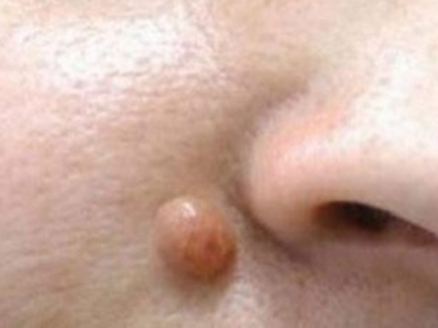 皮膚纖維瘤面部長了個大的圓結節圖 皮膚纖維瘤面部長了個大的圓結節圖