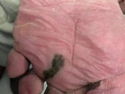 原位惡性黑色素瘤腳底黑斑圖 原位惡性黑色素瘤腳底黑斑圖