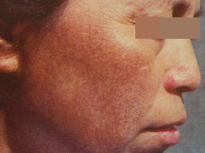 瑞爾黑變病臉頰上有褐色的斑圖