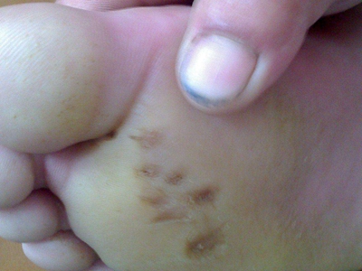 溝狀跖部角質松解症腳底有黑色的坑圖