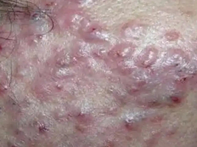 嗜酸性膿皰性毛囊炎面部結節有血痂圖 嗜酸性膿皰性毛囊炎面部結節有血痂圖