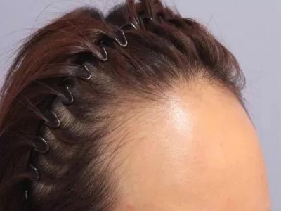 女性型脫髮前額髮際線後移圖 女性型脫髮前額髮際線後移圖