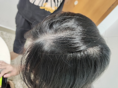 雄激素性脫髮頭皮有一塊缺少頭髮圖