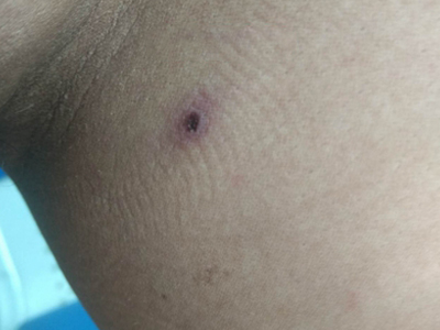 恙蟲病大腿黑色火山口樣焦痂圖 恙蟲病大腿黑色火山口樣焦痂圖