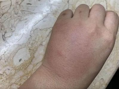蠓蟲叮咬手腫了圖 蠓蟲叮咬手腫了圖