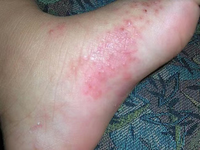嬰兒肢端膿皰病腳部長紅斑和水皰圖 嬰兒肢端膿皰病腳部長紅斑和水皰圖
