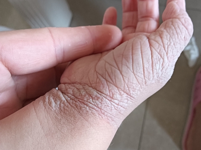 窩狀角質松解症手部皮膚鬆弛發白圖 窩狀角質松解症手部皮膚鬆弛發白圖