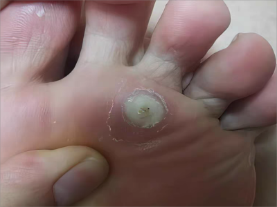 胼胝腳底有灰白色的硬塊起皮圖 胼胝腳底有灰白色的硬塊起皮圖