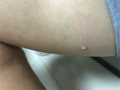 小汗腺汗孔瘤大腿根上有個小紅疙瘩圖 小汗腺汗孔瘤大腿根上有個小紅疙瘩圖