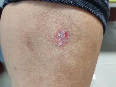 尋常型銀屑病小腿有硬幣大小斑塊圖