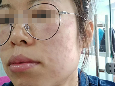 海鮮過敏面部長了好多丘疹圖 海鮮過敏面部長了好多丘疹圖