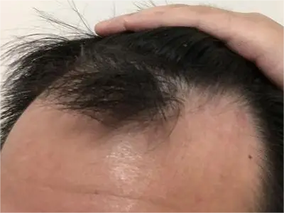 男性型脫髮額頭髮際線上移圖