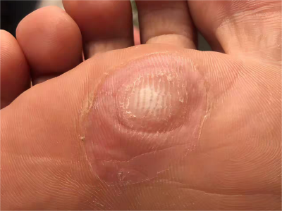 胼胝腳底有圓形硬塊圖