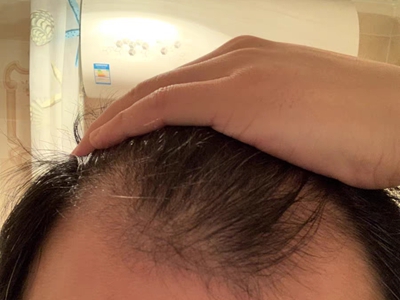 雄激素性脫髮頭頂髮際線衰退圖 雄激素性脫髮頭頂髮際線衰退圖