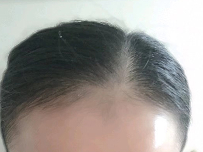 雄激素性脫髮頭髮脫落髮際線後移圖 雄激素性脫髮頭髮脫落髮際線後移圖
