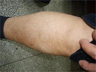 特發性滴狀色素減少症小腿起白斑圖 特發性滴狀色素減少症小腿起白斑圖