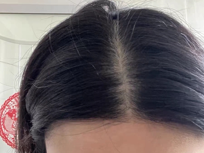 女性型脫髮頭頂中間發縫很明顯圖