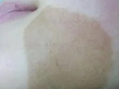 咖啡斑下巴頦有一片較大的咖啡色斑圖 咖啡斑下巴頦有一片較大的咖啡色斑圖