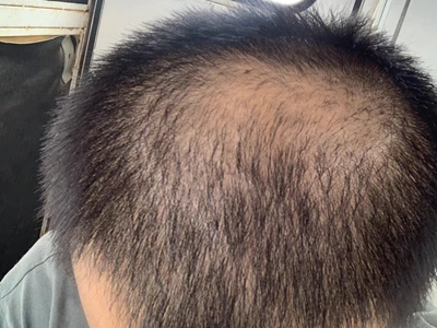 雄激素性脫髮頭頂一塊沒有頭髮圖