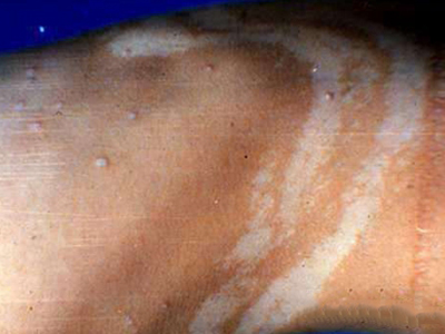 脫色性色素失禁症小腿上出現白斑圖 脫色性色素失禁症小腿上出現白斑圖