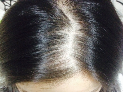 女性型脫髮頭頂脫髮露頭皮圖 女性型脫髮頭頂脫髮露頭皮圖