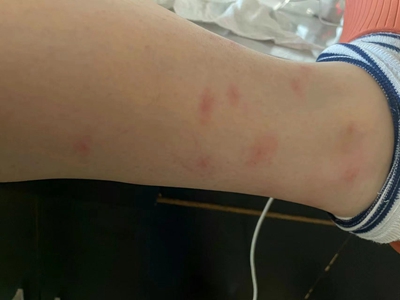 蚊子叮咬小腿起紅疙瘩圖 蚊子叮咬小腿起紅疙瘩圖